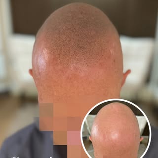 ➡️ Swipe for at se hvad en Scalp Micropigmentation (SMP) transformation kan! 

🌟 På billederne ser 