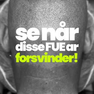 Har du ar, der udfordrer dig?👇🏻

Scalp Micropigmentation (SMP) kan være din løsning!

🙌 Denne kli