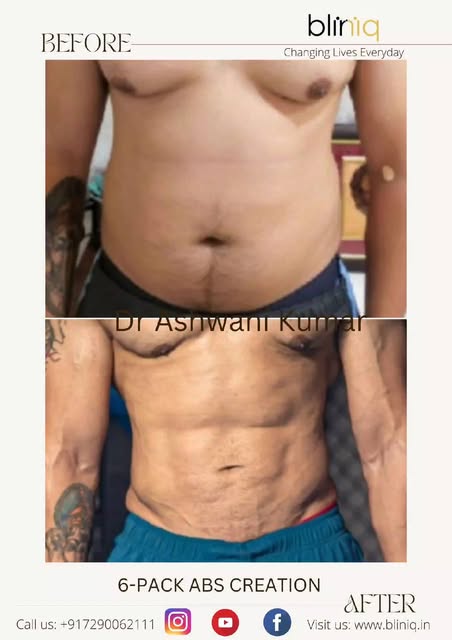 Abdominal Etching a.k.a Six pack abs creation at BLINIQ . Call on 7290062111 for appointment