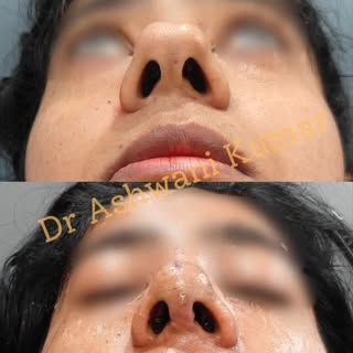 Before & After | Open Rhinoplasty by 
Dr. Ashwani Kumar
Another beautiful transformation at BLINIQ C