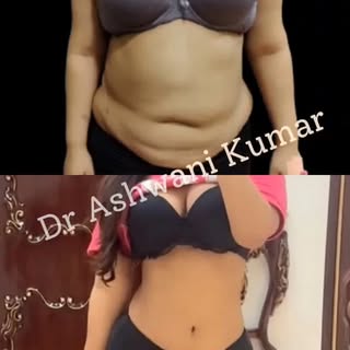 ✨ 1 Year Transformation After Liposuction ✨
Watch this incredible journey of our patient who underwe