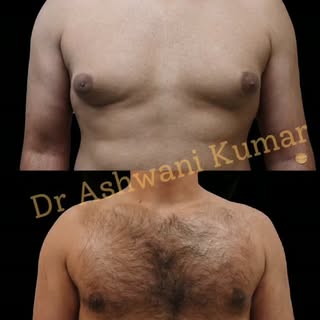 ✨ 4 Months After Gynecomastia Surgery – The Confidence is Back! 💪

From hiding behind loose T-shirt