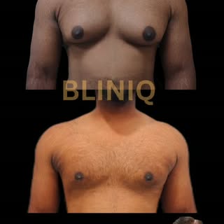 Gynecomastia Grade 2b Results at 3 weeks . Patient is experiencing 
- renewed confidence after the p