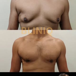 Gynecomastia Treatment