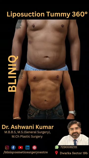 Liposuction 360