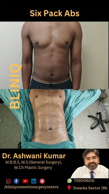 SIX-PACK ABS — CREATED ON THE OPERATING TABLE 🔥

What if your abdomen could be sculpted with the sa
