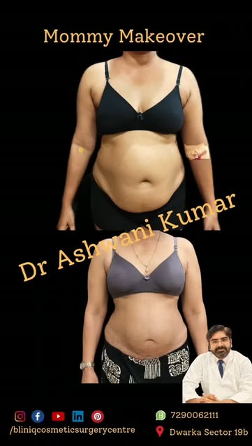 ✨ MOMMY MAKEOVER | 6-WEEK TRANSFORMATION ✨

From stubborn abdominal fat to a more defined waistline!
