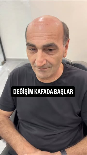 Özgüven, Motivasyon, Mutluluk
Sadece 2 Saatte Hepsini Geri Kazanın..
S-Well Hair Protez Saç Merkezle