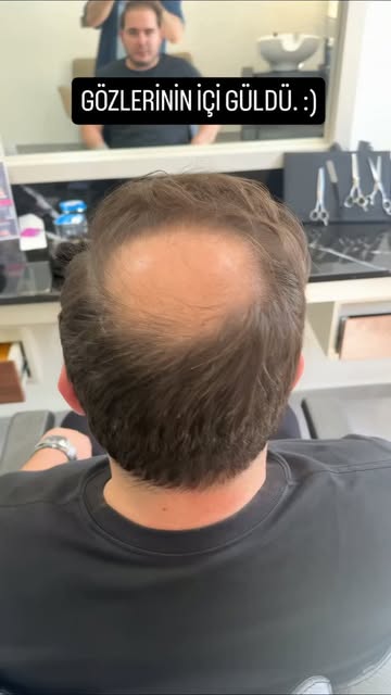 Özgüven, Motivasyon, Mutluluk
Sadece 2 Saatte Hepsini Geri Kazanın..
S-Well Hair Protez Saç Merkezle