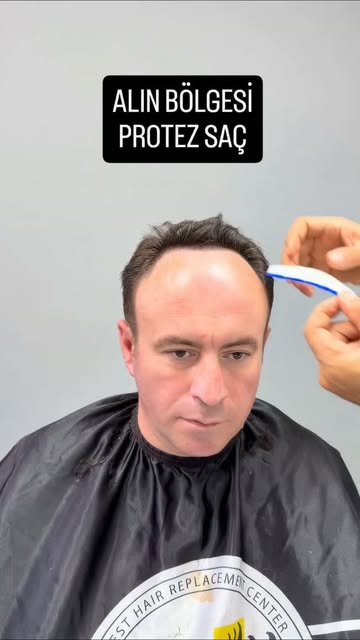 Alın bölgesi saçsızlık problemleriniz için frontal protez saç... 

S-Well Hair Protez Saç Sistemleri