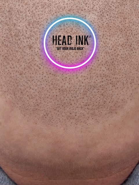 ROUND ONE COMPLETE!

Stay tuned for round two! 

SMP is a multi session treatment💯

#northampton