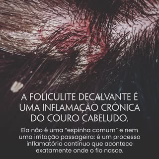 A Foliculite decalvante é uma doença inflamatória que pode destruir o folículo e levar à queda de ca