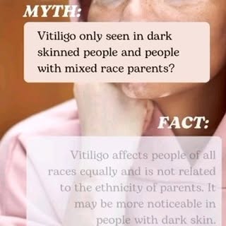 Vitiligo #trichy #skincare