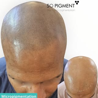 Lorsque la perte de cheveux est avancée et que la densité capillaire a pratiquement disparu, la micr