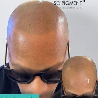 Un effet rasé court ultra naturel grâce à la tricopigmentation. Une seconde jeunesse retrouvée, recr