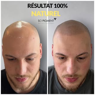 Vous voyez la différence ? 👀  Mon client a beaucoup hésiter, il a 22 ans et assume sa perte de chev