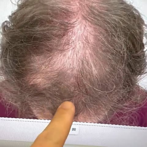 A hair transplant doesn't stop future hair loss. While transplanted follicles are permanent, your ex