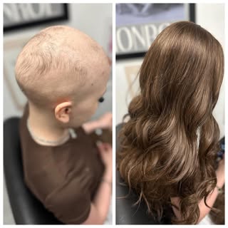 Alopecia comes in many different forms: but a very common example of Alopecia, is Alopecia Areata, w