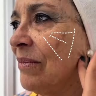 Si crees que todo se soluciona con ácido hialurónico probablemente te estás equivocando.

Hay pieles