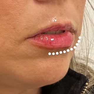✨ Labios bonitos no significa labios exagerados. 

En este tratamiento hemos aportado hidratación, d