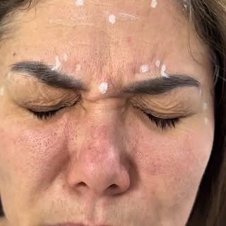 ✨ Resultados naturales, elegantes y progresivos ✨

En este reel puedes ver la evolución de los neuro