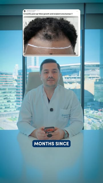 Five months after a hair transplant and still not seeing much growth? Don’t panic yet.
A patient on 
