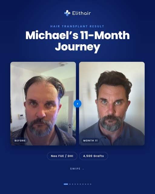 Hair Transplant Results: Michael’s 11-Month Transformation 👀🔥

Looking for real hair transplant re