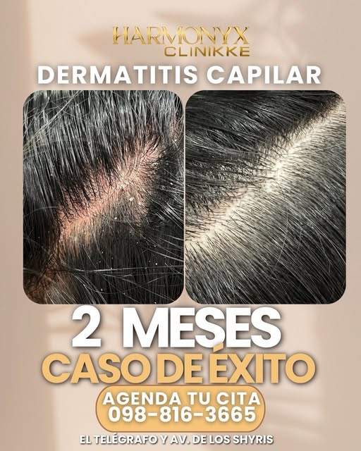 ¿Sufre de molestias, descamación o irritación en el cuero cabelludo? Les compartimos este increíble 