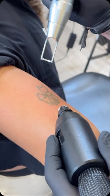 Tattoo-Entfernung in den Niederlanden – 50 % günstiger als in Deutschland! 🔥

Vereinbare jetzt schn