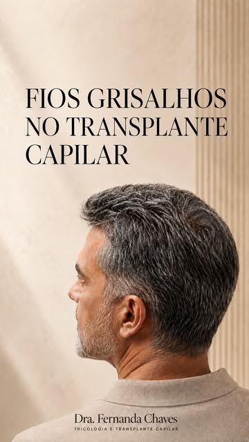 De onde veio esse cabelo?

O folículo transplantado preserva características da área doadora. Por is