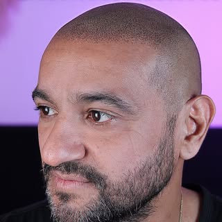 Trabajo de micropigmentación capilar realizado con técnica hiperrealista, diseñada para devolver def