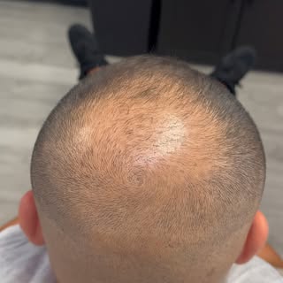 Just because you’ve had a hair transplant doesn’t mean the journey is over. 💉 My client came in wan