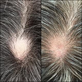 Curious about SMP? Scalp Micropigmentation (SMP) is strategically tattooing impressions that look li