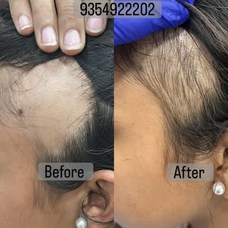 One month results