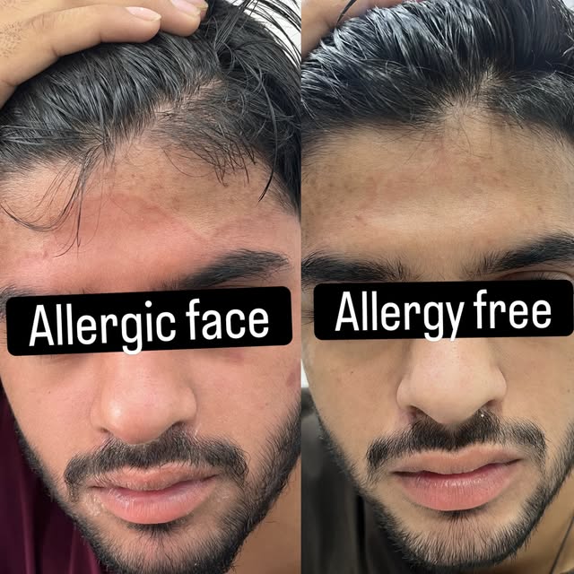 9354922202
9871222202
#drpallavisharmadadri #drpallaviskinandhaircare #skinclinicdadri #laserclinicd