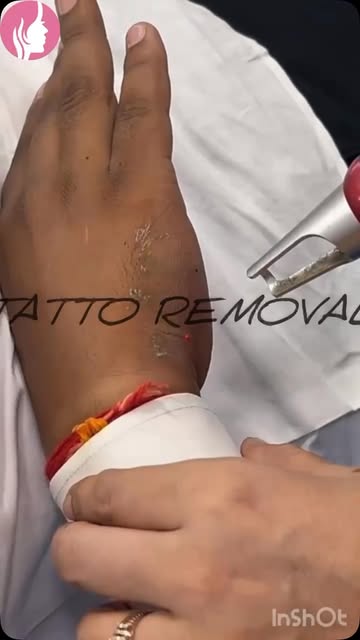 9354922202/9871222202 #tattoremovaldadri #lasertattooremoval #drpallavisharmadadri #dadrilasertretme