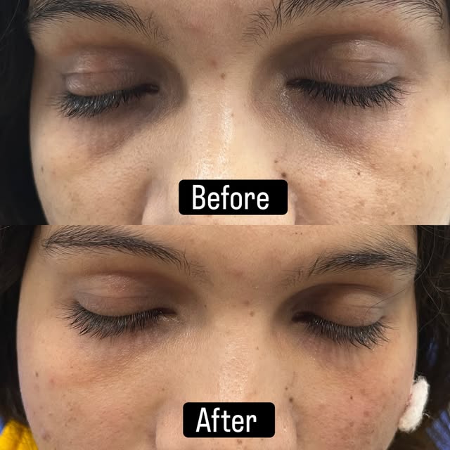Undereyehollowness gone in a single session 🌸 #undereyecircles #undereyedarkcirclestreatment #drpal