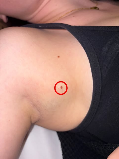 1 month post-electrocautery of raised mole:

This client had a raised mole that had bothered her for