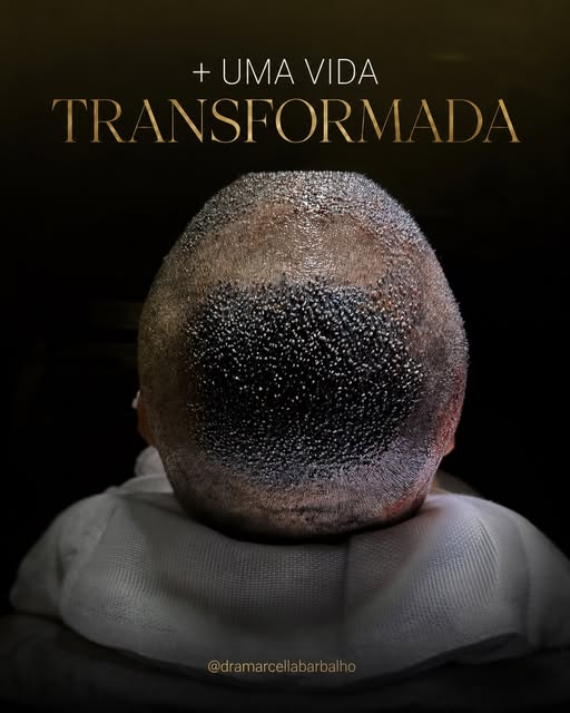 ✨ Mais uma vida transformada.

Por trás de cada transplante capilar existe uma história, uma expecta