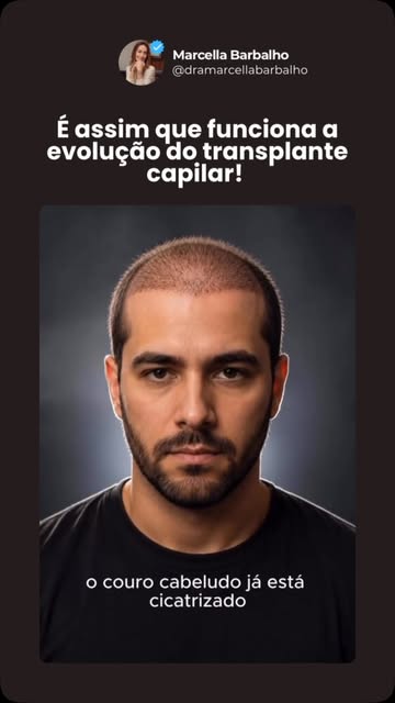 Gostou de saber sobre a 
evolução do transplante capilar?