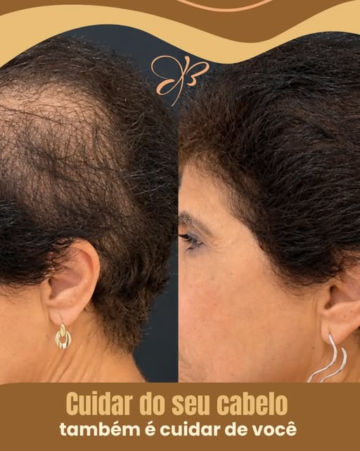 ✨ ANTES E DEPOIS DE UM RESULTADO DO ESPAÇO RENOVA! ✨

Cada cabelo tem uma história, e cuidar dos fio