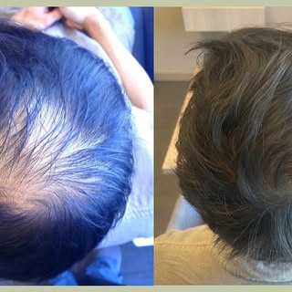 Antes y después de tratamiento de Células Madres. Cambios que cambian la vida!!