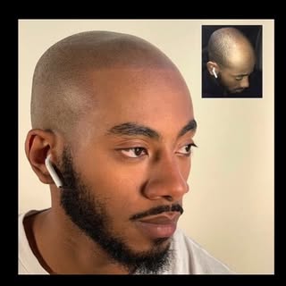 Here is an example of the difference scalp micropigmentation can make with a receding hairline. 

Th
