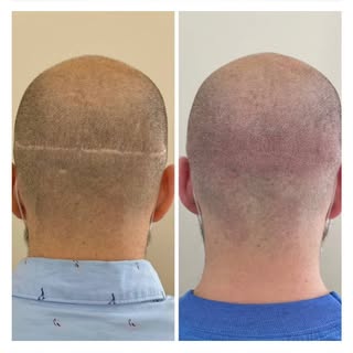 This is an example of how scalp micropigmentation (SMP) can be used to cover and camouflage scarring