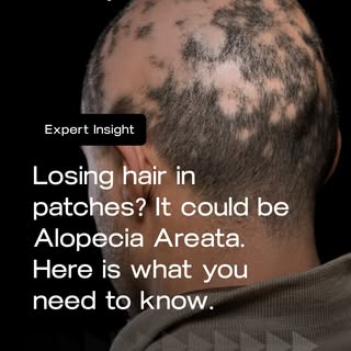 Noticing patchy hair loss and not sure what is causing it? It could be Alopecia Areata, and you are 