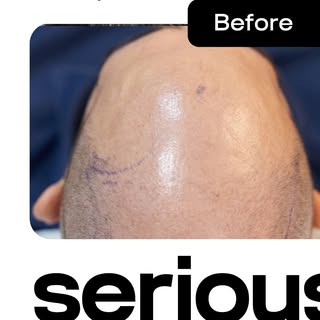 12 months. One decision. A result worth seeing.

This is a real patient of Dr. Bobby, 12 months post