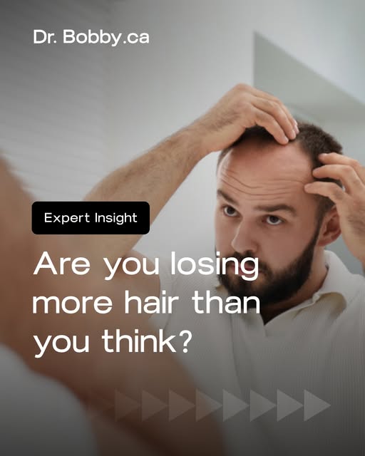 Most people do not notice hair loss until it has already been progressing for a while.

That is beca