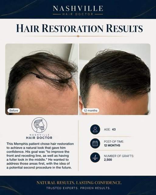 Real patient. Real results. 🙌

This 43 year old patient came to Nashville Hair Doctor wanting to im