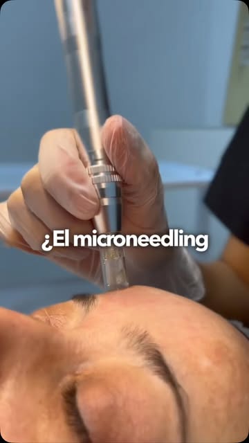 Microneedling : Facts dermatologicos, porque me he topado unos tratamientos en casa que algunos de u
