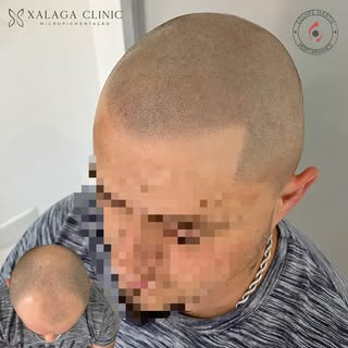 Discreto e perfeito! Esse é o resultado da micropigmentação capilar ✔️

Campeão em Micro Capilar 🏆
